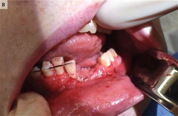 电子烟在奥斯丁口腔中发生了爆炸，几颗牙齿直接被炸掉。
