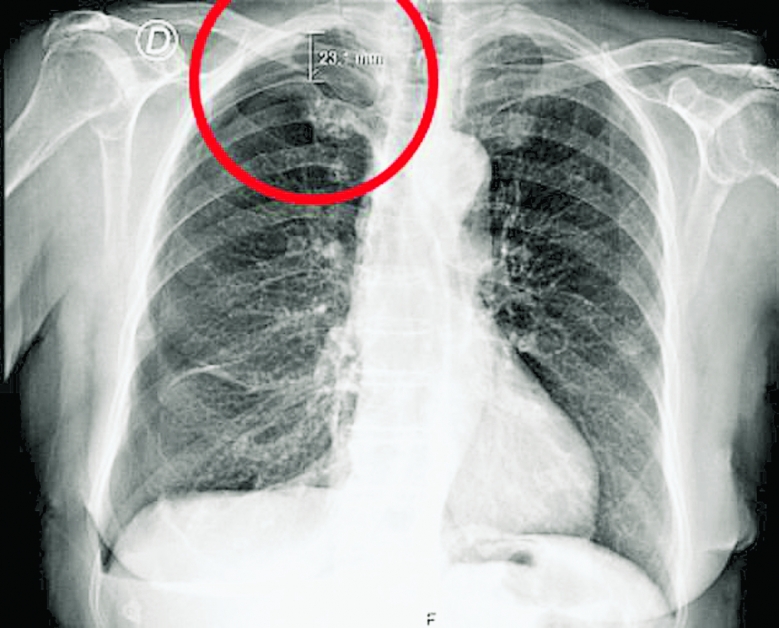 老妇胸部的X光片显示其右肺上部的塌陷状况（红圈）。