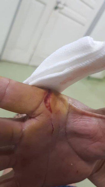 张先生的右手掌被巴冷刀砍伤，缝了3针。