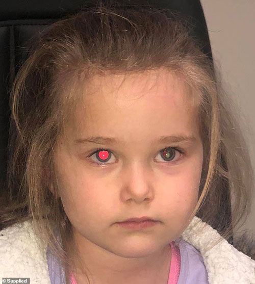 海恩替女儿拍照时，发现照片中只有右眼出现红眼现象，左眼却有一个白色的小点。