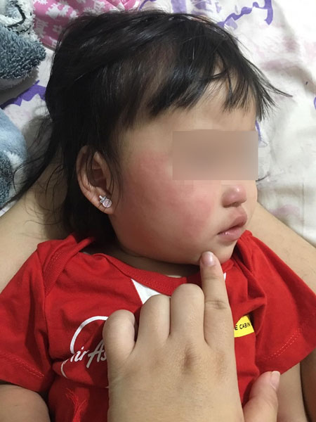 一时疏忽，没有为婴儿椅消毒，导致宝宝整张脸开始红、痒、热、脖子整圈都发红发痒。