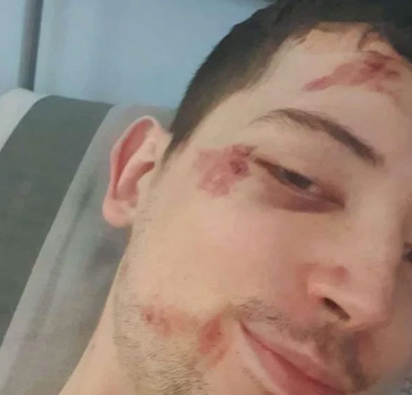 沃尔什的朋友凯尔也被殴打，脸部受伤。