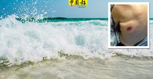 海滩戏水染食肉菌  66岁男两天后死亡