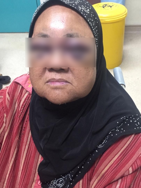 受害者被孙女婿殴伤脸部。