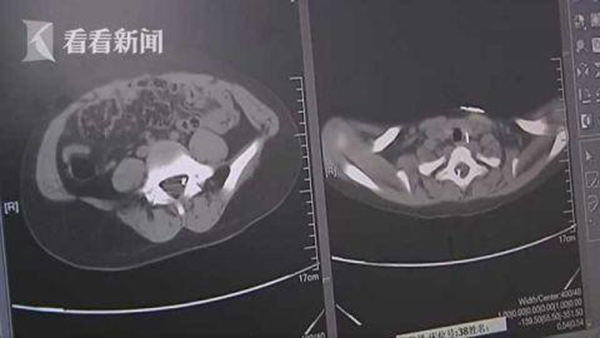 电脑断层扫瞄（CT Scan）照片发现孩子身体里有3根钢针.