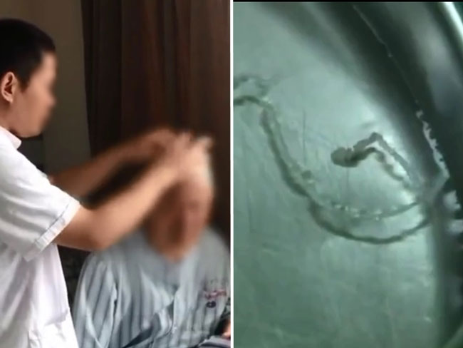 医生（左）检查张男头部，发现里面住着一条寄生虫（右）。