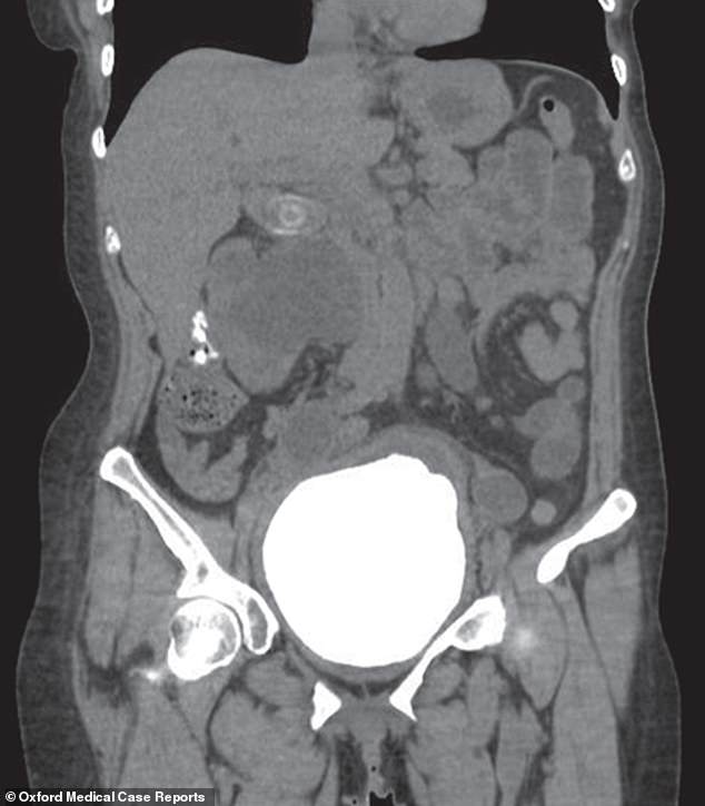 医生扫描时发现女子膀胱里有个大结石。