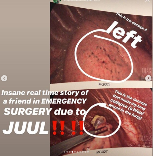 阿米拉达朋友在社交网站上公布吸食Juul电子烟直肺部穿洞的消息。