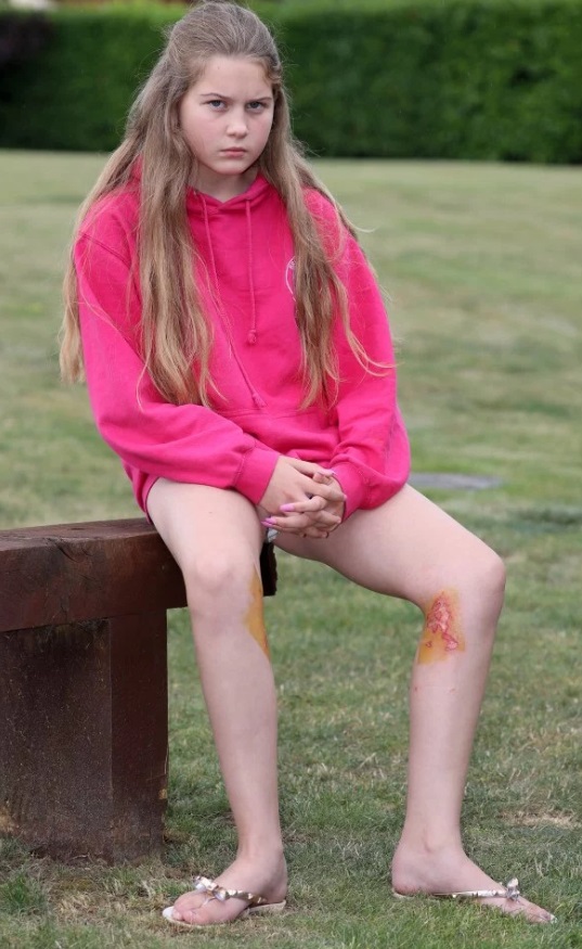 女童沃丝芙德双腿遭Primark美甲胶水灼伤，留下疤痕。