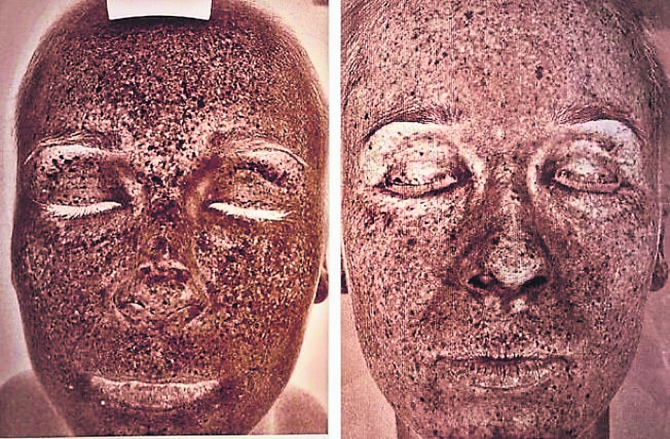 碧安卡做皮肤检测，左图为原本的肤质，色素沉淀严重；右图则为治疗一个月后的状况，肤质明显改善。