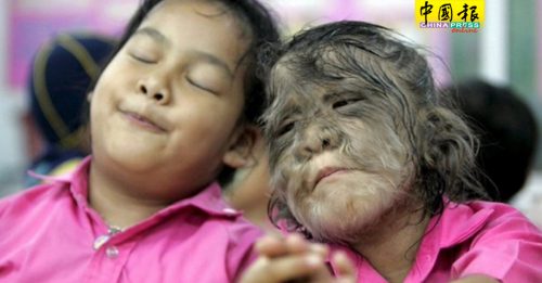 胃药被生发药污染  西班牙16童长浓毛