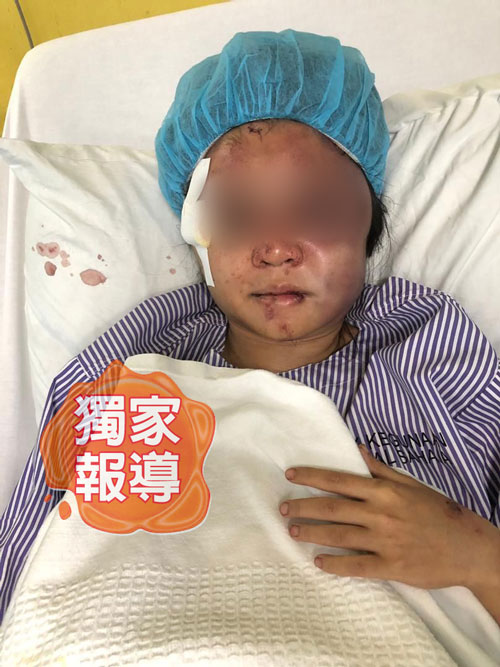 伤者被男友及2名友人围殴，导致脸部瘀青红肿。