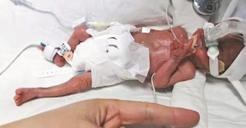 出生仅540克拇指姑娘  广州超早产女婴奇迹存活