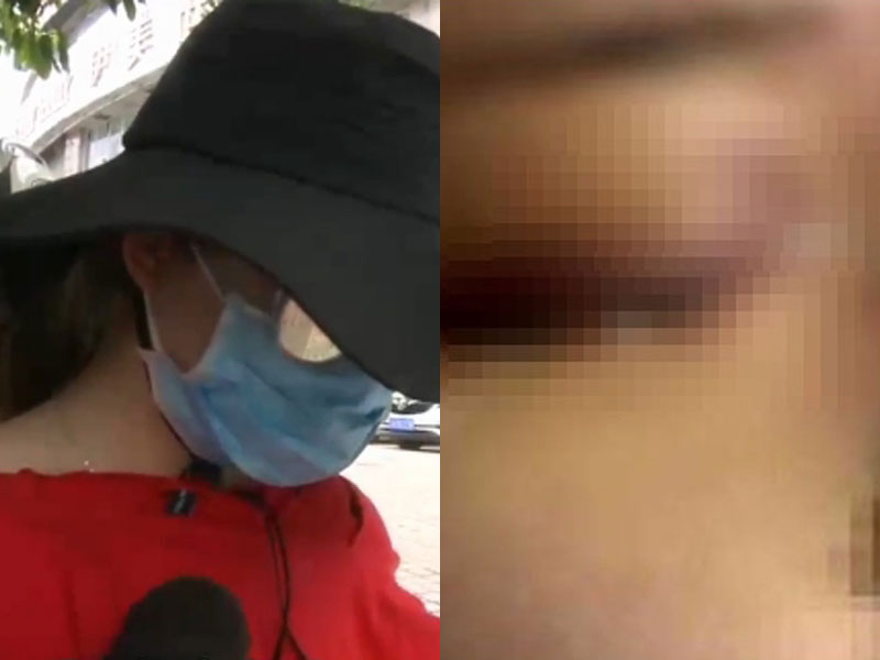 19岁女孩爱美打玻尿酸 ,一针下去眼睛却失明了!