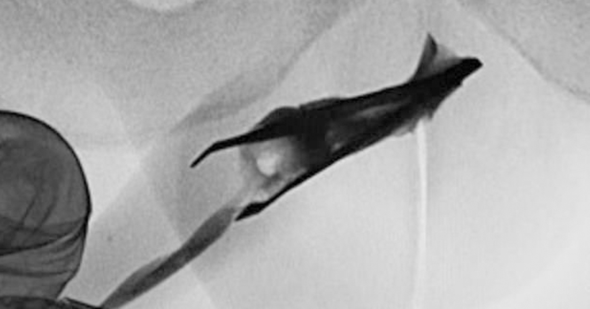 经过X光检查后发现，有根长达8公分的镊子在男子的生殖器末端。