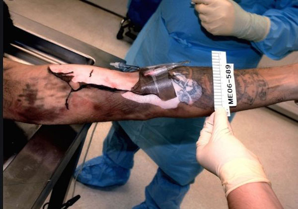 迪亚兹手臂因为化学性灼伤导致皮肤变黑，外层甚至撕裂露出红色与白色的血肉。