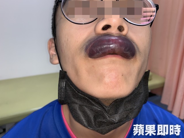 男大生打篮球不慎被撞到嘴唇,隔天就医时,嘴唇已肿成如挂着一条香肠。