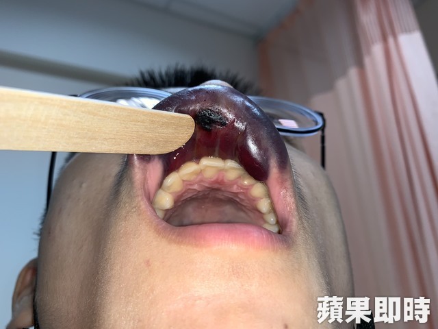 医生翻开男大生上唇,内部口腔黏膜已有部分坏死。