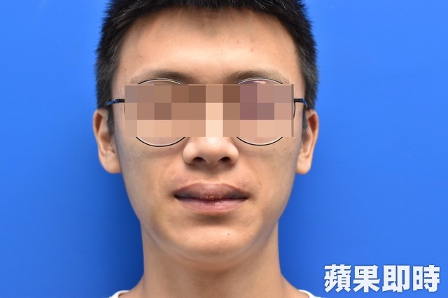 男大生经手术后,隔周回诊,嘴唇已恢复原状。