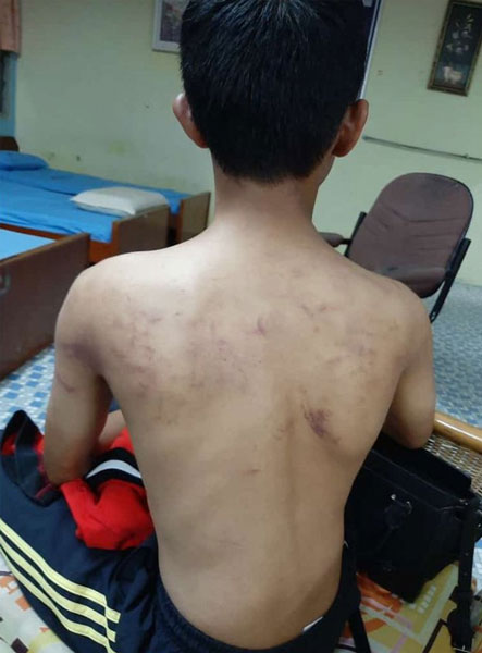 一名中学寄宿男生，被15名同学群殴后，背部伤痕累累。（取自网络）