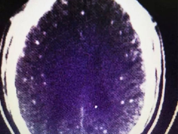 X光照显示朱男脑部有白点，属病变状态。