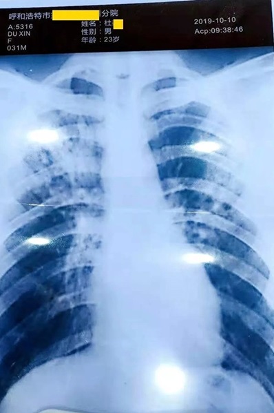 杜男托人伪造身患肺结核的X光片。
