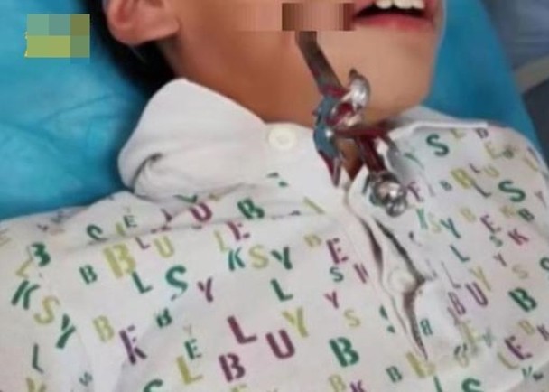 男童被玩具剑刺穿脸颊。