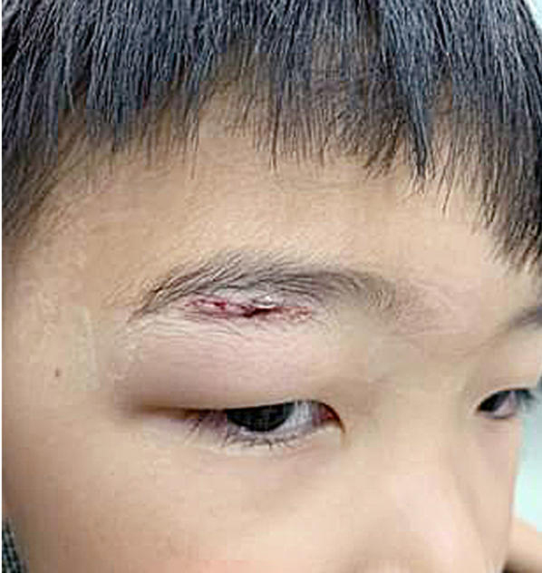 男童在星耀樟宜的镜子迷宫内，右眼眉毛下方处被划伤。 