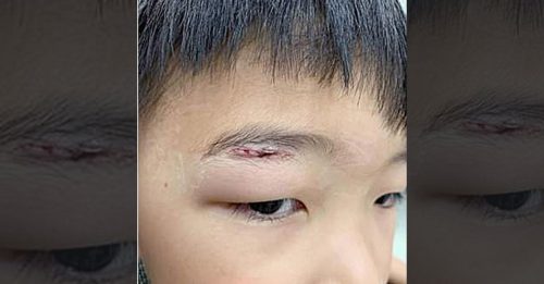 星耀樟宜玩镜子迷宫 8岁大马男童割伤眼