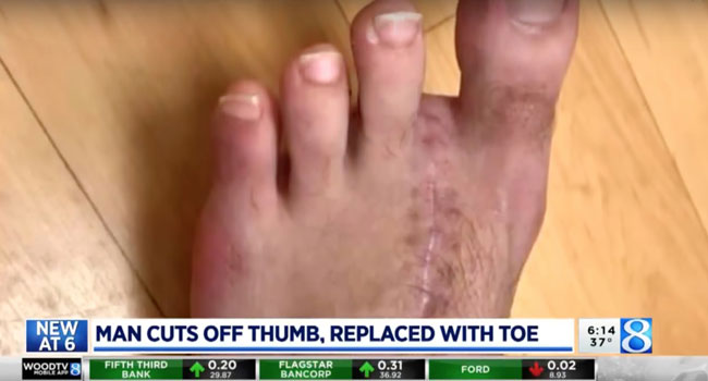阿特金斯请医生协助，以左脚的食指来代替被自己误切断的拇指。
