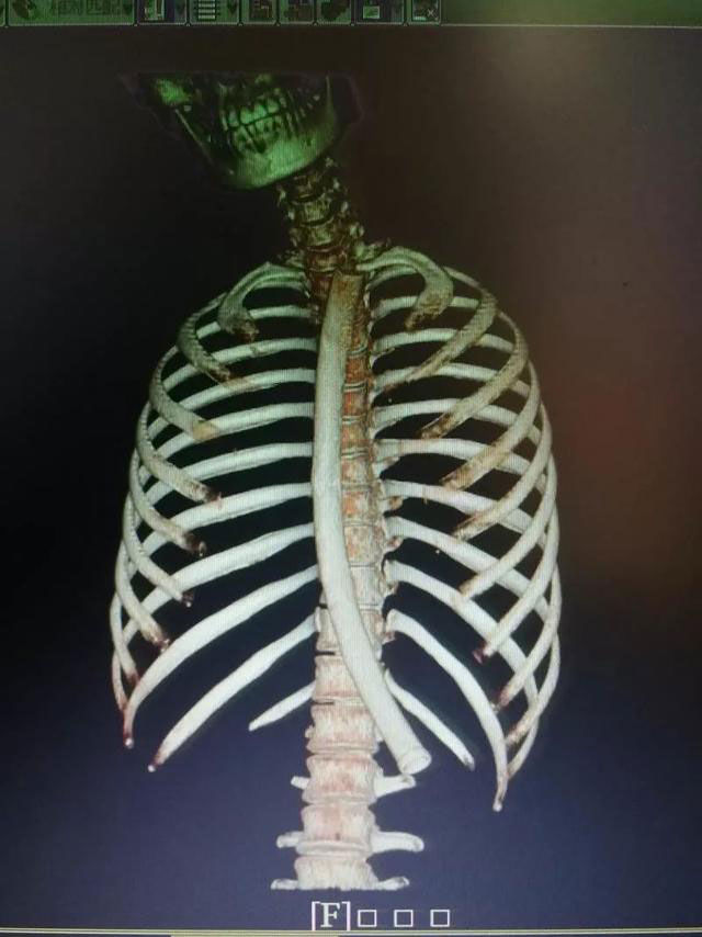 催吐管底端在胃部，顶着胃壁。