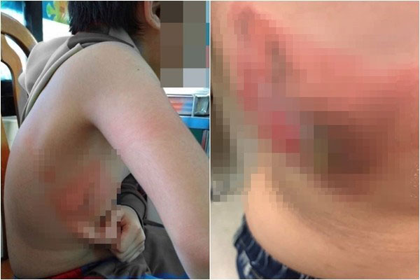男童遭到同学喷热水烫伤，右侧胸壁、手臂都起水泡脱皮。（翻摄面子书“基隆人踹共”）