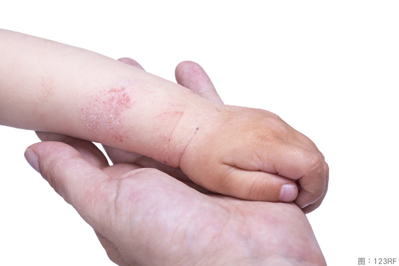 Eczema on the skin of the kid's hand