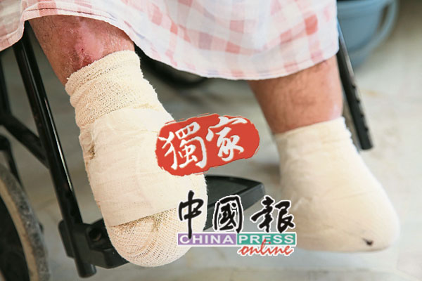 在2017年因玻璃片刮破脚板后，叶家善伤口迟迟不能复原，被迫锯去一双脚板。