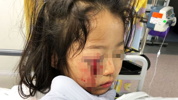 女童塞西莉亚右眼被挂衣服的金属挂勾插伤。