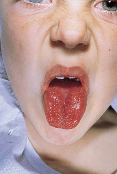 川崎氏症的病征之一——草莓舌。