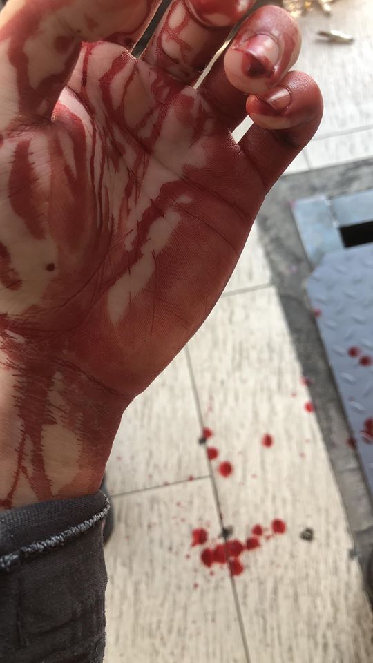 华裔男子的手部被砍伤，血流不止。