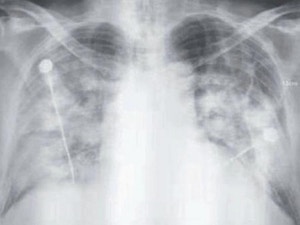 新型冠状病毒肺炎的胸部X光片。