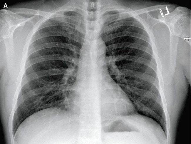 美国首例武汉肺炎患者X光，肺部出现白斑条纹。
