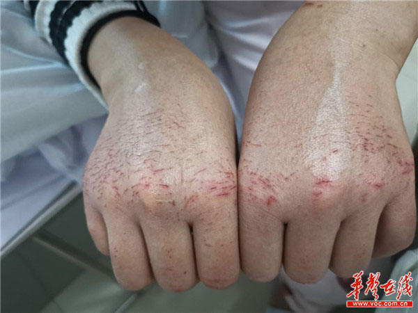 湖南22岁护士双手龟裂出血。
