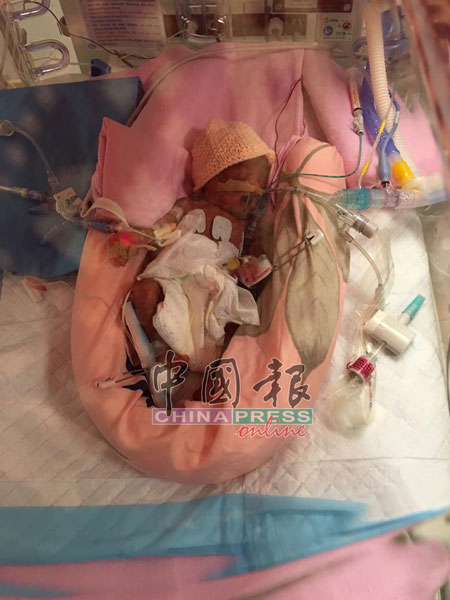早产双胞胎姐妹，其中妹妹苏俐宁仍在加护病房接受治疗。