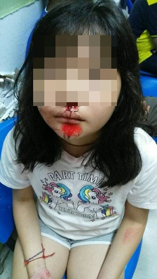 小女孩的面部擦伤。