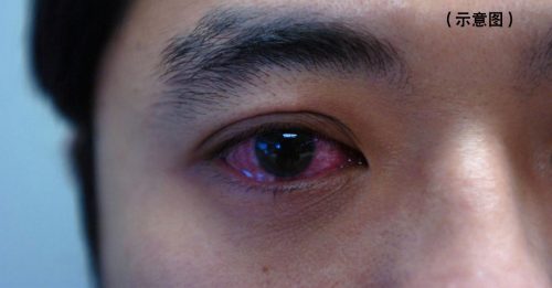 ◤全球大流行◢ 眼睛发红是新症状？ 美护士警告：注意你的眼睛