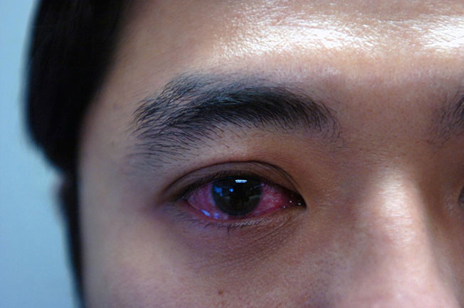 眼睛发红可能是新冠病毒感染的一个明显迹象。