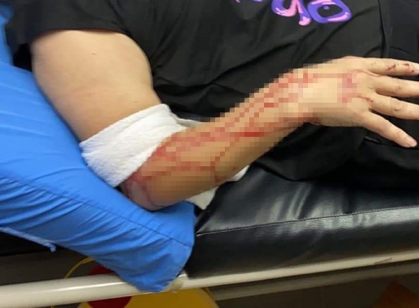 华妇右手也被咬一个洞，缝了最少10针。