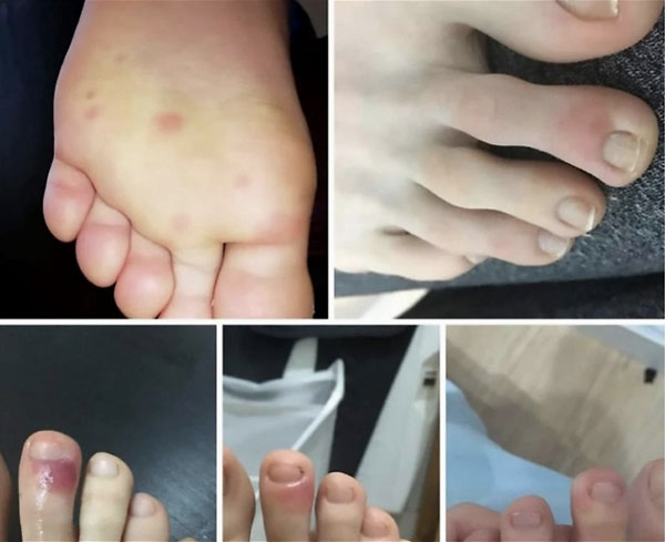 西班牙医学专家研究发现，脚部“类似水痘”病变极可能是新冠肺炎的“早期预警信号”。