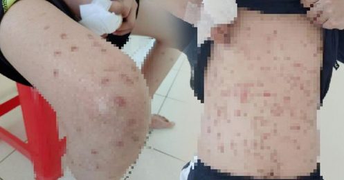 打工遭凌虐被当标靶 少年全身被BB弹打成蜂窝