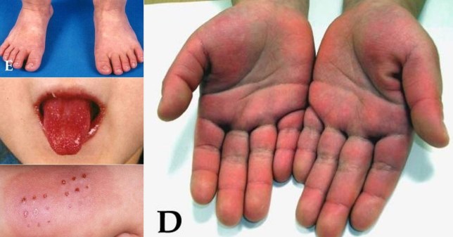 川崎病症状包括5天以上持续高烧、眼睛发红、发疹和颈部肿胀。