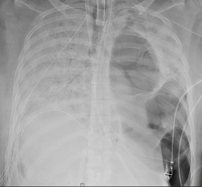 新冠肺炎病毒摧残下肺部的X光照片。