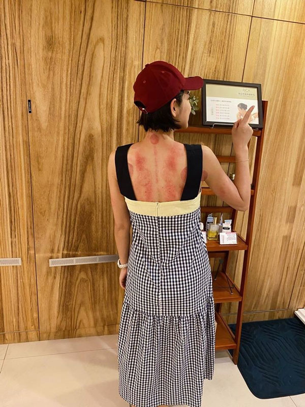 米可白晒出背部全是红痧的照片，让粉丝相当担心。